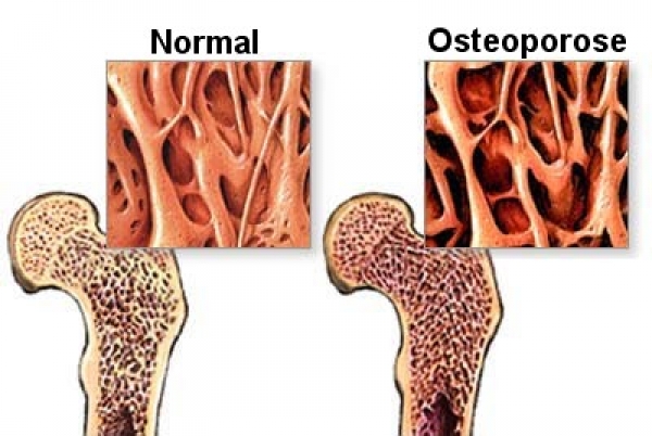 OSTEOPOROSE X ALIMENTAÇÃO